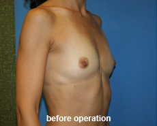 plastic-surgery-breast-augmentation